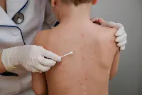 allergie alimentari